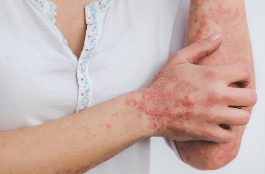  Shocking Facts About Psoriasis