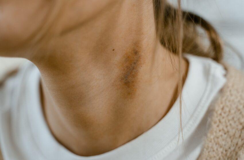  Things You Didn’t Know About Acanthosis Nigricans