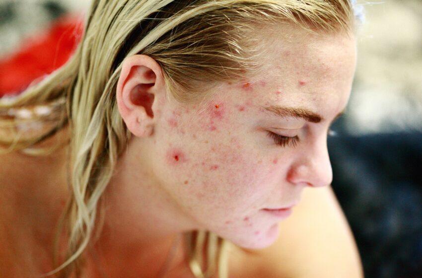  Most Effective Ways To Overcome Acne’s Problem