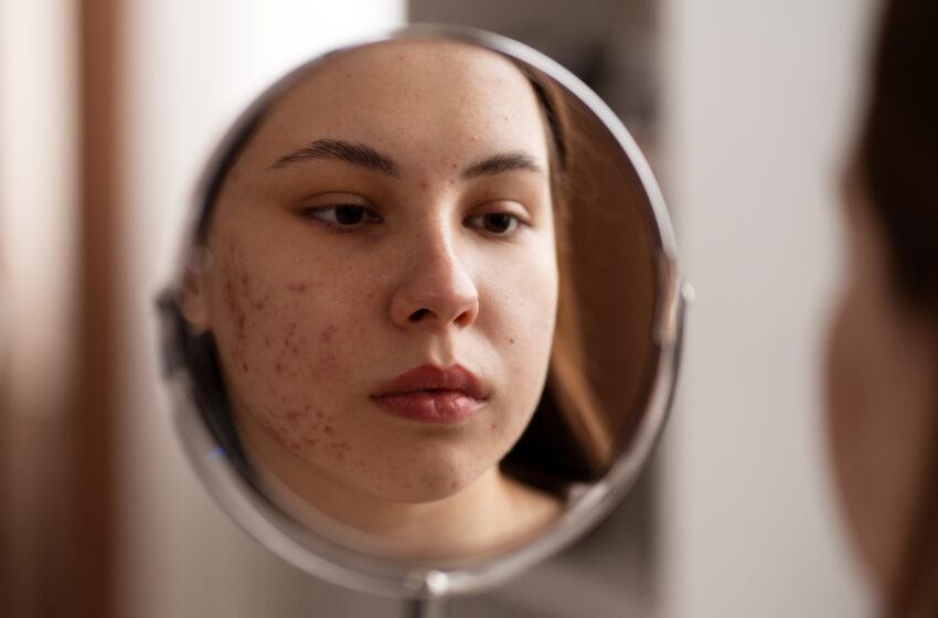  Tretiva 20: A Game-Changing Solution for Acne-Free Skin
