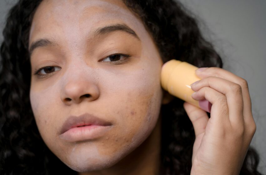 Beyond Blemishes: Nurturing Confidence Despite Acne Challenges