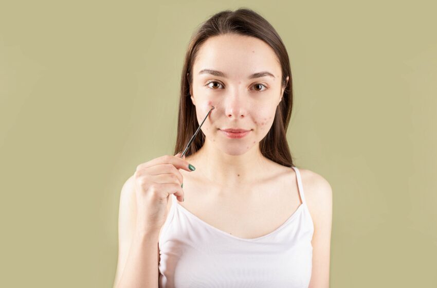 Popping Pimples Safely